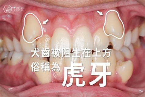 虎牙面相|虎牙是什麼？虎牙成因、影響及解決辦法一次看 